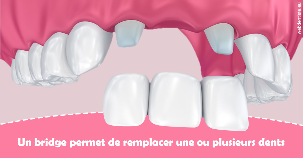 https://www.dr-feraud-pedodontiste.fr/Bridge remplacer dents 2