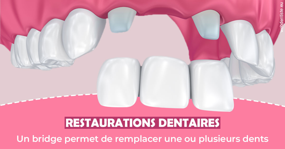 https://www.dr-feraud-pedodontiste.fr/Bridge remplacer dents 2