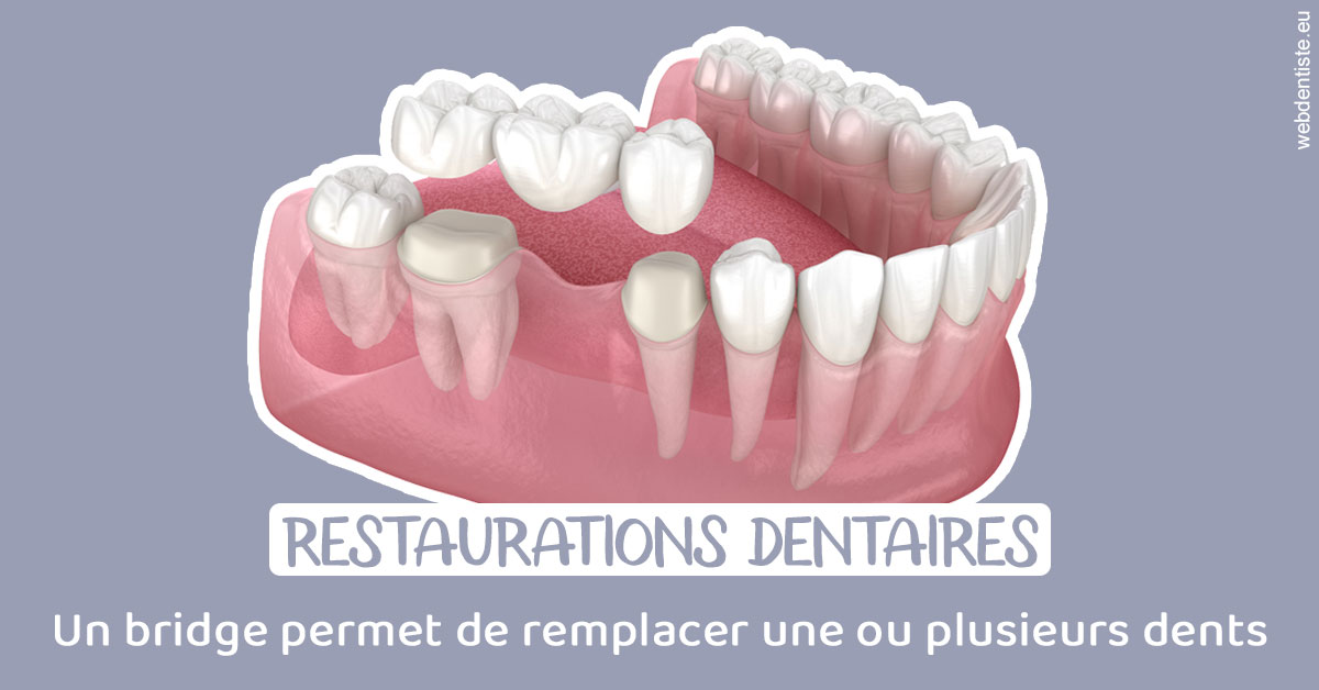 https://www.dr-feraud-pedodontiste.fr/Bridge remplacer dents 1